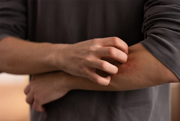 Skin Irritation and Rashes